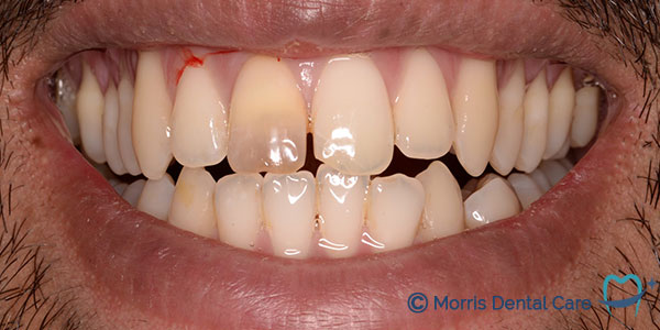 Before treatment the patient had crowded teeth which inhibited good oral care (teeth cleaning)